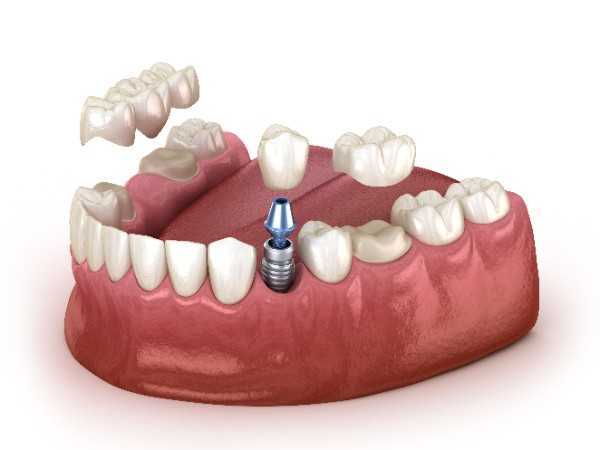 dental implants Bromsgrove
