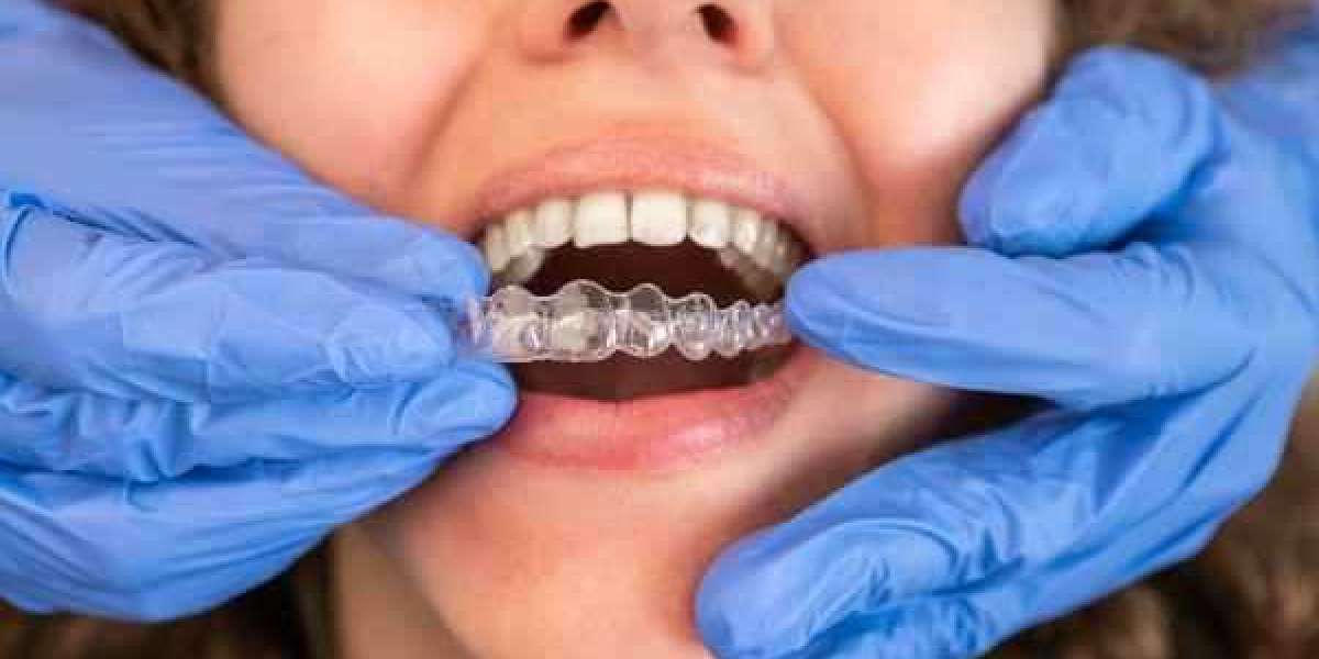 The Growing Trend: Adults Opting for Clear Aligners Over Braces