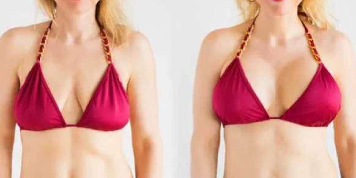 Breast Lift In Bangalore