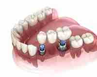 Image Source - Emergency Dentist Wrexham