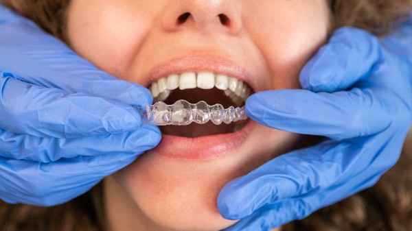 Invisalign Wigan 