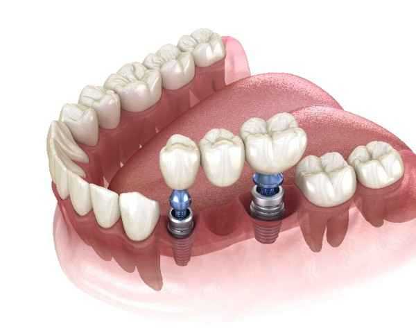 dental implants Wigan