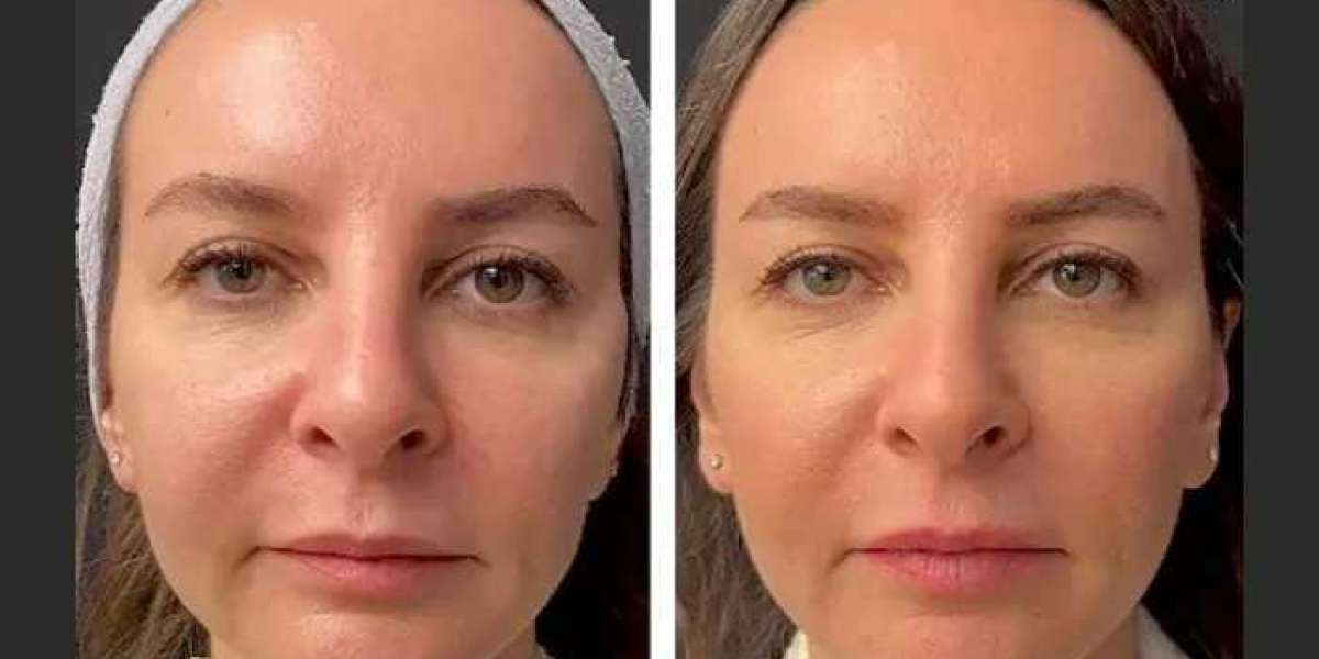 Customized Mesotherapy at Best Aesthetic Clinic in Dubai