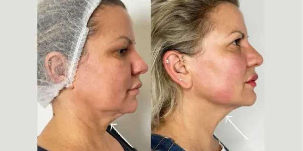 Best Aesthetic Clinic in Dubai for Laser Facelift Alternatives
