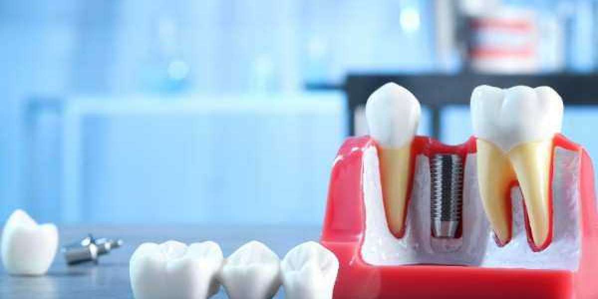 Warrington Smile Makeovers: Combining Implants & Invisalign