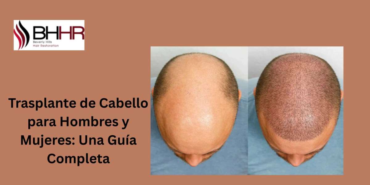 Trasplante de Cabello para Hombres y Mujeres: Una Guía Completa